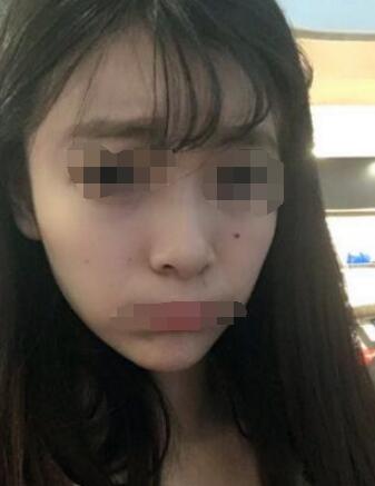 南宁全面部填充案例