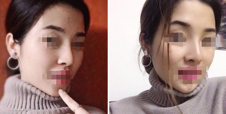 长沙单纯硅胶隆鼻案例