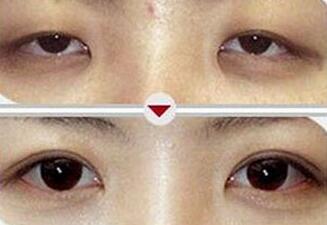 大慶公立醫院上瞼下垂矯正價格范圍：3000-10000元/例