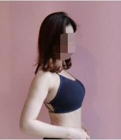 厦门假体隆胸案例