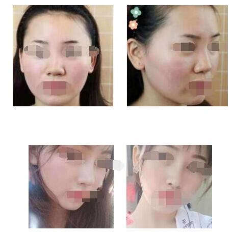 韓士生科鼻硅膠假體