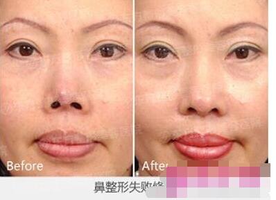 郑州东方医院贺洁割双眼皮口碑技术介绍