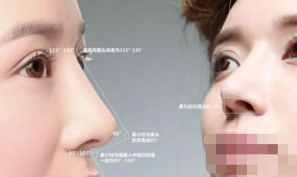 成都假体隆鼻修复案例