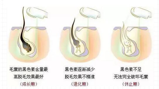毛发生长有3个时期,在这个时期脱毛效果更显著