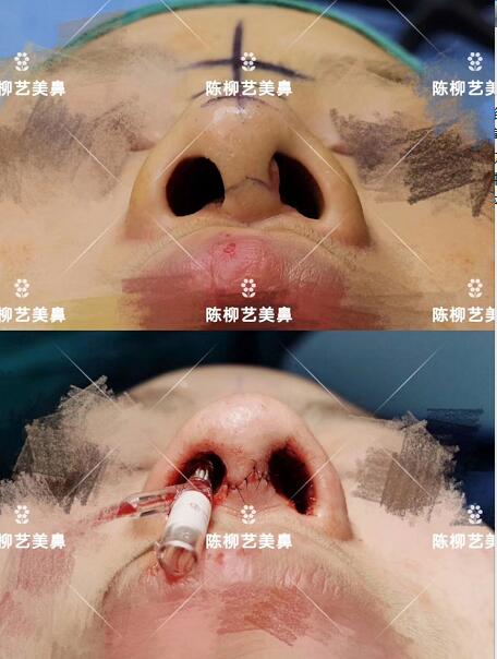 湖南韩美整形陈柳艺医生耳软骨综合隆鼻案例展示