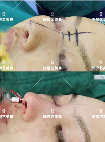 湖南韩美整形陈柳艺医生耳软骨综合隆鼻案例展示