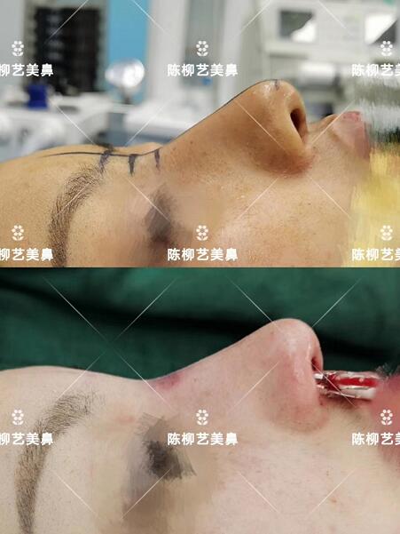 湖南韩美整形陈柳艺医生耳软骨综合隆鼻案例展示