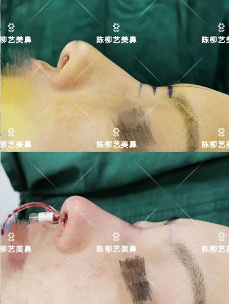 湖南韩美整形陈柳艺医生耳软骨综合隆鼻案例展示