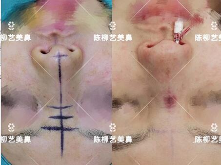 湖南韩美整形陈柳艺医生耳软骨综合隆鼻案例展示