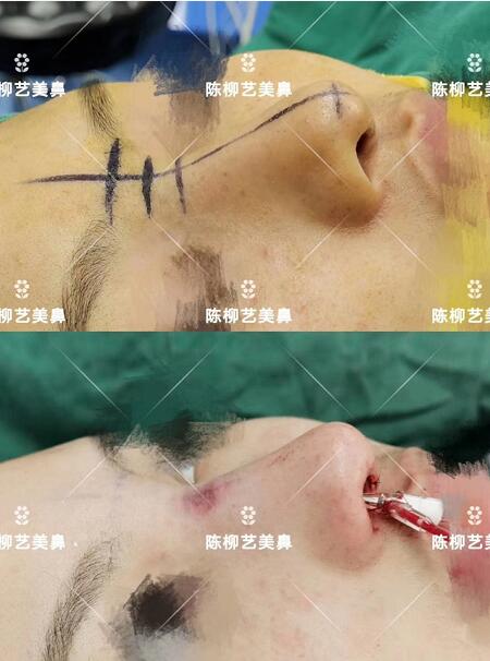 湖南韩美整形陈柳艺医生耳软骨综合隆鼻案例展示