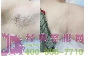 呼倫貝爾激光脫腋毛2020全新價格表 2200-3300元/療程 