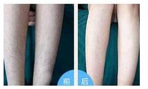 呼倫貝爾大小腿脫毛全新價格表出爐了 4000-6000元/療程 