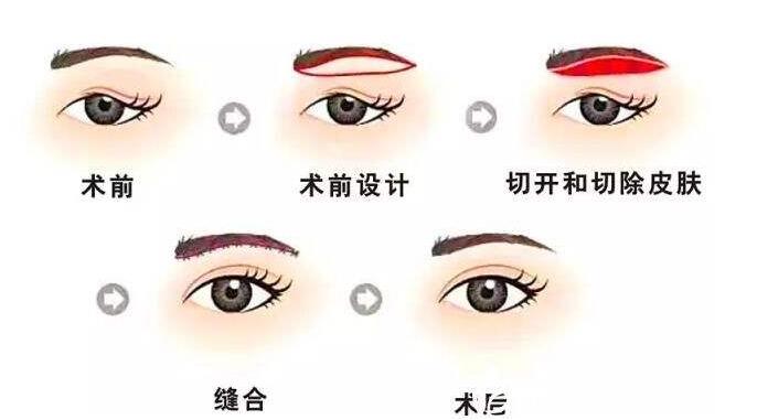 重庆提眉手术全新价格参考已出