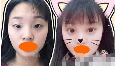 深圳美莱整形林登文简介介绍+双眼皮经典案例