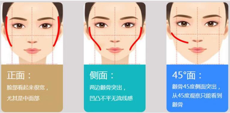 珠海这样子能够帮你确定是颧骨高还是太阳穴凹陷