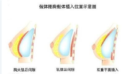 我平胸,我骄傲吗?还是来看看隆胸能不能颠覆你的生活