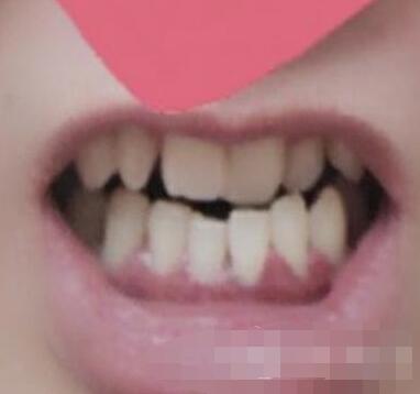 口腔牙齿矫正案例 术后变得非常自信