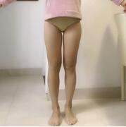 大腿吸脂案例 看看我这瘦了一圈的大腿