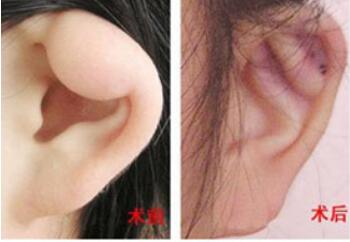 呼倫貝爾耳垂畸形修復(fù)全新價(jià)格表來了