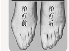 呼倫貝爾寬腳變窄參考報價 3000-6000元/例 附加經(jīng)典案例