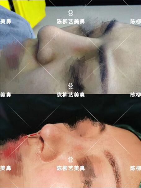 湖南韓美整形陳柳藝醫生美鼻案例