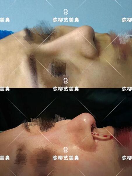 湖南韓美整形陳柳藝醫生美鼻案例