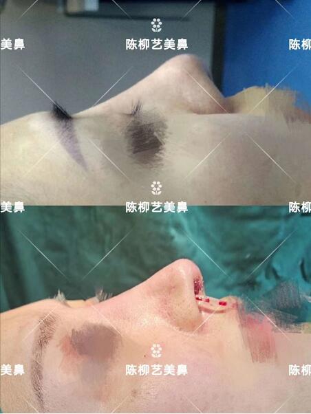 湖南韓美整形陳柳藝醫生美鼻案例