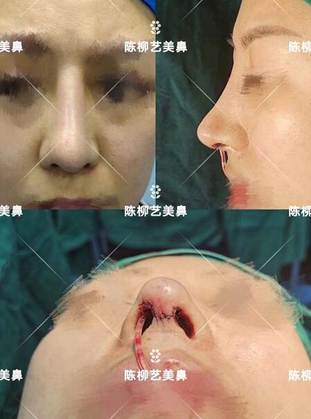 湖南韓美整形陳柳藝醫生美鼻案例