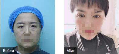 上海美莱整形“杜氏传奇美眼”打造者——杜园园医生