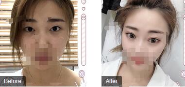 上海美莱整形何祥龙医生的“明眸翘睫大眼术”效果展示