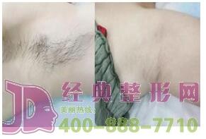 巴彥淖爾激光脫腋毛五月特惠曝光 2700-5000/療程 