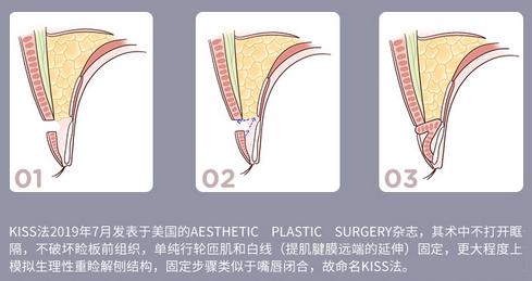 上海华美整形董亮医生特色项目——KISS法双眼皮,仿生自然