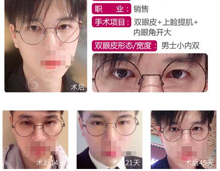 上海华美整形董亮医生特色项目——KISS法双眼皮,仿生自然
