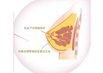 五月关注:乳房凹陷矫正手术治疗方法曝光