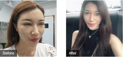 福州台江整形徐婷婷医生的自体脂肪移植面部填充技术展示