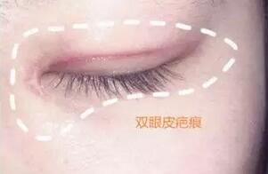 美丽不打折！双眼皮出现疤痕和增生的解决办法