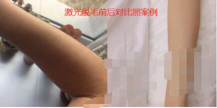 盤錦手臂激光脫毛術的6月價格表