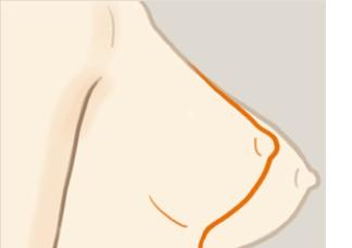 上海巨乳缩小手术的价格