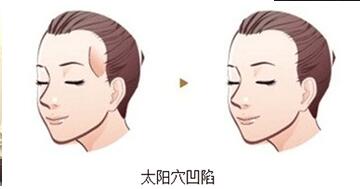 如何看起来更可爱、更显年轻些呢?上海玻尿酸丰太阳穴的价格?