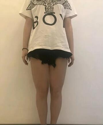 深圳大腿吸脂价格参考,你也可以成为别人的羡慕对象
