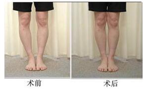 巴彥淖爾O型腿矯正七月全新價格表出爐了 22000-35000元/例