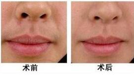 烏蘭察布激光脫唇毛八月價格特惠很親民 2000-4000元/療程 