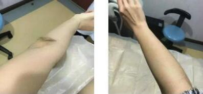 烏蘭察布全身脫毛八月全新價格表上線了 20000-30000元/療程 