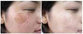 烏蘭察布王者風(fēng)范八月價格特惠上線 8000-20000元/療程 
