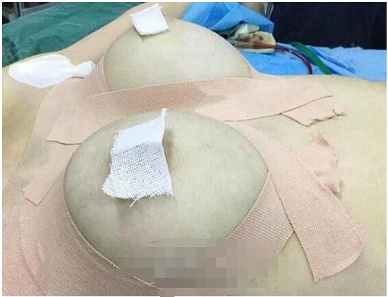 湖南人民医院李高峰医生自体脂肪丰胸案例 术后35天乳沟很诱人