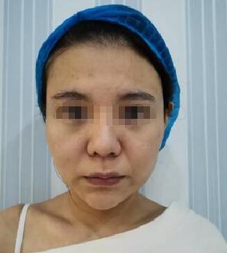 面部年轻化医生:武汉乐美整形汪文娟的埋线提升术