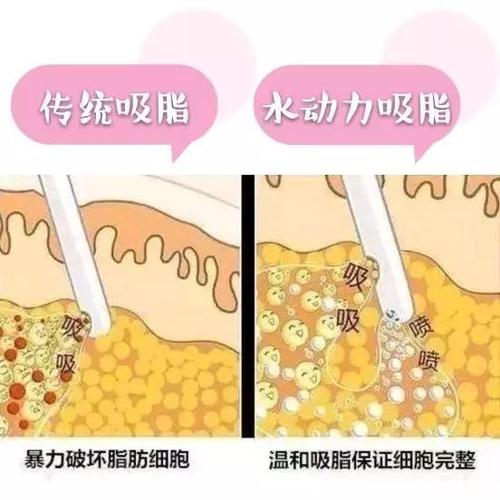 水动力吸脂瘦大腿