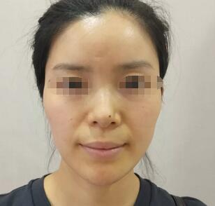 武汉匠歆天巧整形医院邓裴医生的自体肋软骨隆鼻效果展示