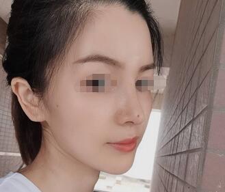 武汉匠歆天巧整形医院邓裴医生的自体肋软骨隆鼻效果展示