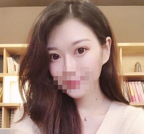 【双眼皮医生攻略】成都艺星医美蔡灵医生的双眼皮效果